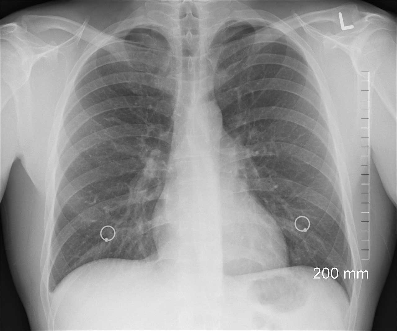 Bluthochdruck Symptom Engegefühl in Brust